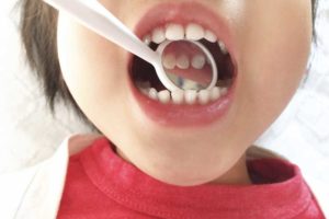子供の治療【小児歯科】