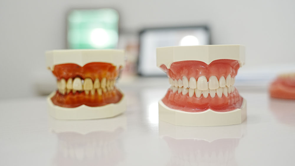 審美歯科治療|歯を綺麗にしたい歯を白くしたいならあわら市さかの歯科クリニック