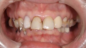 前歯6本をセラミック治療1|あわら市さかの歯科クリニック
