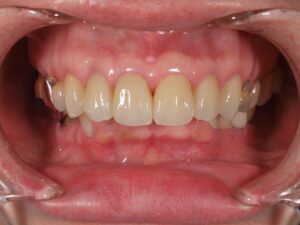 前歯6本をセラミック治療2|あわら市さかの歯科クリニック