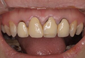 前歯4本をセラミック治療|症例2before