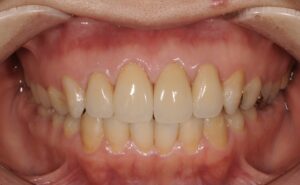 前歯4本をセラミック治療|症例2after