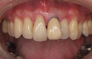 前歯1本をセラミック治療|症例3before