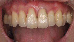 前歯1本をセラミック治療|症例3after