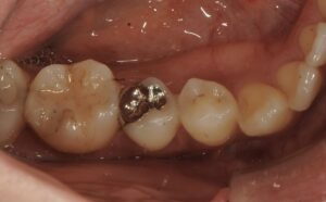 奥歯の銀歯1本を部分セラミック治療|症例4before