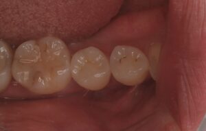 奥歯の銀歯1本を部分セラミック治療|症例4after