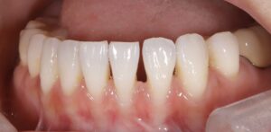 前歯の隙間を自費のレジン充填治療|症例5before