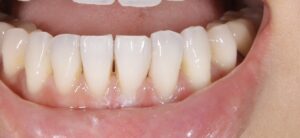 前歯の隙間を自費のレジン充填治療|症例5after
