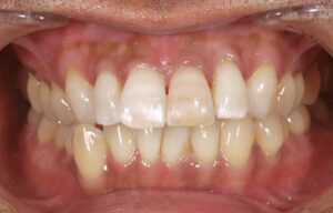 神経が死んで黒くなっている前歯をホワイトニング(歯の内側から行うホワイトニング)after