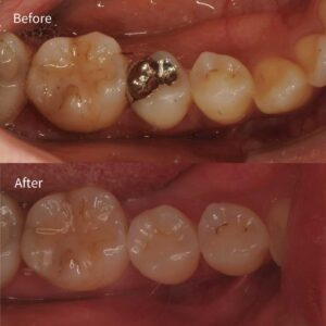 奥歯の銀歯1本を部分セラミック治療