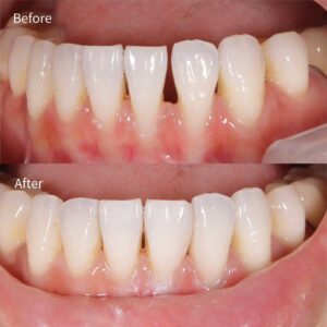 前歯の隙間を自費のレジン充填治療